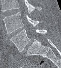 Scoliosis -  Spondylolisthesis image