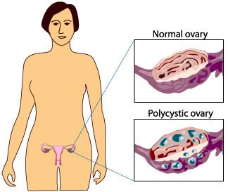 pcos image