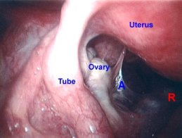 pelvic adhesion